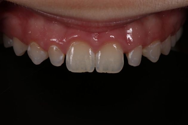 Dental Bonding - Teeth Bonding  Peg Laterals Bonding  - Before
