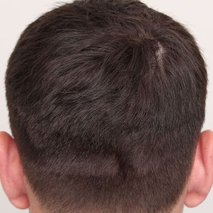 Hair Transplant - Donor Area Afters: FUE - Before FUE