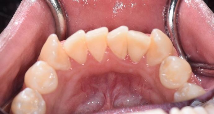 Periodontal Cleaning: Case 7 - Port Lavaca, TX - After