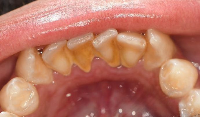 Periodontal Cleaning: Case 7 - Port Lavaca, TX - Before