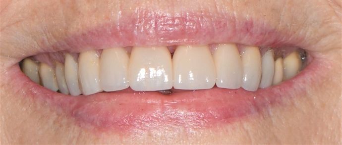 Porcelain Veneers: Case 3 - Victoria, TX - After