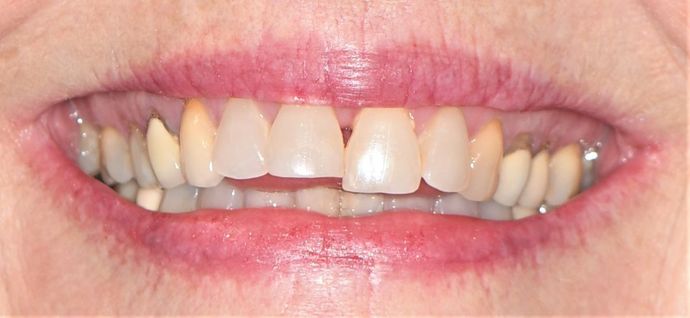 Porcelain Veneers: Case 3 - Victoria, TX - Before