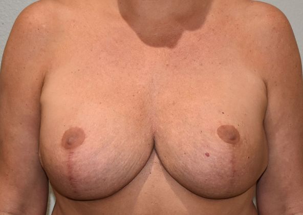 Breast Revision: Case 152 - Before