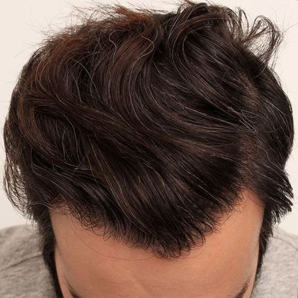Male Before And After Hair Transplant Photos Frontal FUT - After