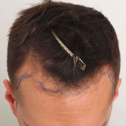 Hair Transplant - Male: Hairline FUT - Case 33 - Before FUT hair transplant