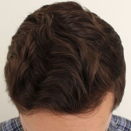 Hair Transplant - Male: Hairline FUT - Case 33 - After FUT hair transplant