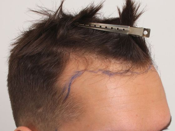 Male Before And After Hair Transplant Photos Hairline FUT - Before