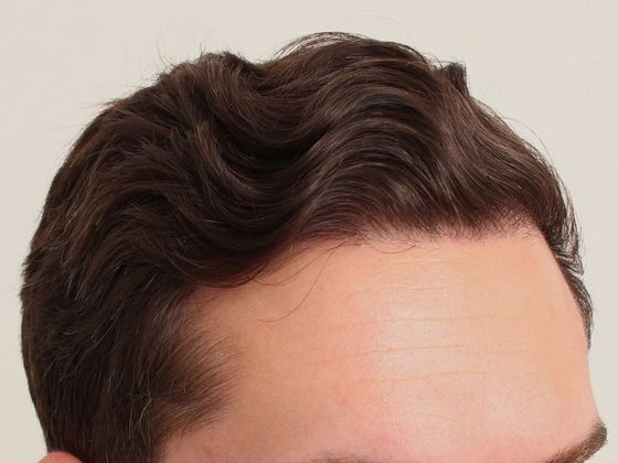 Male Before And After Hair Transplant Photos Hairline FUT - After