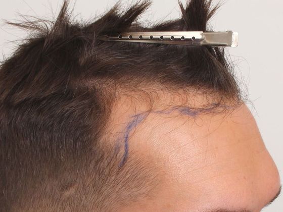 Hair Transplant - Male: Hairline FUT - Case 33 - Before FUT hair transplant