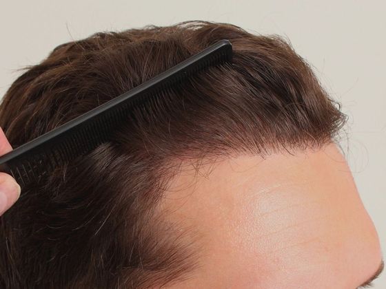 Hair Transplant - Male: Hairline FUT - Case 33 - After FUT hair transplant