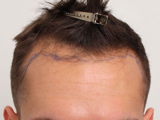 Hair Transplant - Male: Hairline FUT - Case 33 - Before FUT hair transplant