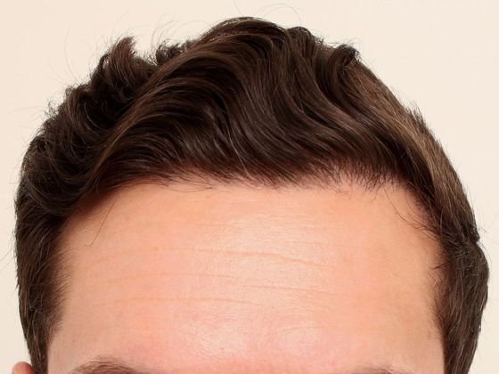 Hair Transplant - Male: Hairline FUT - Case 33 - After FUT hair transplant