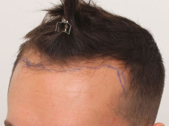 Hair Transplant - Male: Hairline FUT - Case 33 - Before