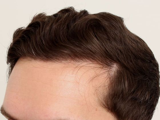 Hair Transplant - Male: Hairline FUT - Case 33 - After