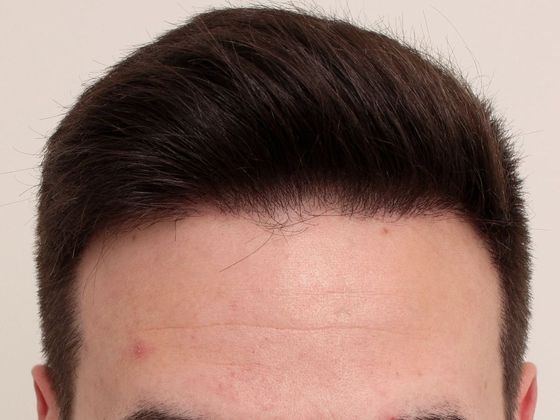 Male Before And After Hair Transplant Photos Hairline FUE (2) - After