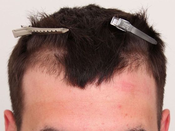 Male Before And After Hair Transplant Photos Hairline FUE (2) - Before