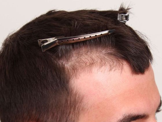 Hair Transplant - Male: Hairline FUE - Case 2 - Before FUE hair transplant