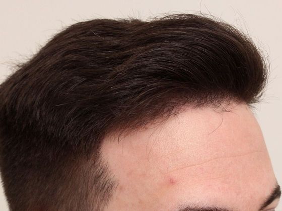 Hair Transplant - Male: Hairline FUE - Case 2 - After FUE hair transplant
