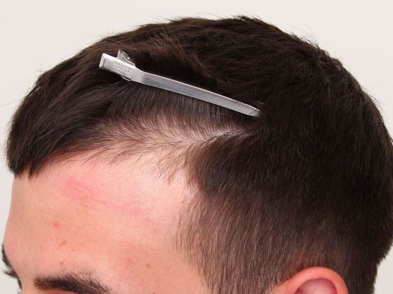 Hair Transplant - Male: Hairline FUE - Case 2 - Before FUE