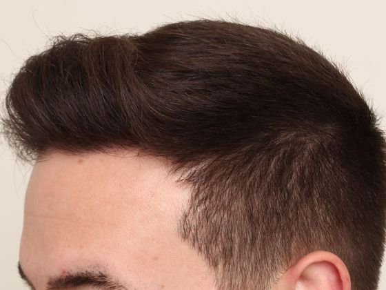 Hair Transplant - Male: Hairline FUE - Case 2 - After FUE hair transplant