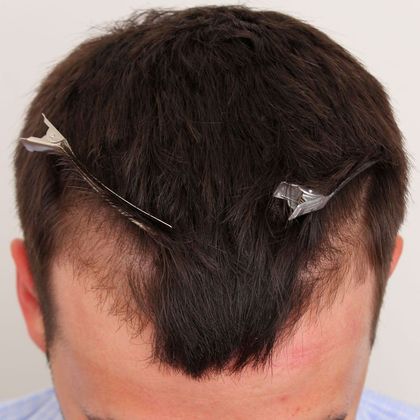 Hair Transplant - Male: Hairline FUE - Case 2 - Before FUE hair transplant