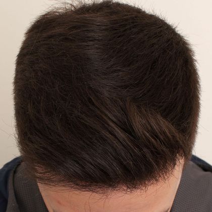 Hair Transplant - Male: Hairline FUE - Case 2 - After FUE hair transplant