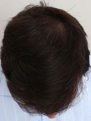 Crown Hair Restoration - Male: Crown (2) - After FUT hair transplant
