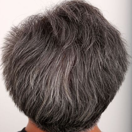 Male Before and After Crown Hair Restoration Photos: Crown - After hair restoration
