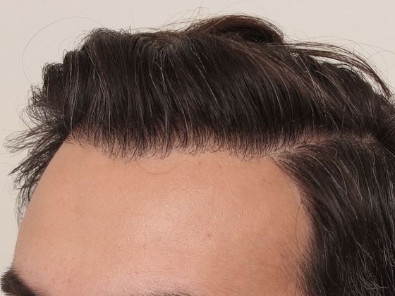 Hair Transplant - Male: Frontal FUT - Case 40 - After FUT hair transplant