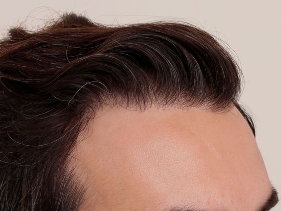 Hair Transplant - Male: Frontal FUT - Case 40 - After FUT hair transplant