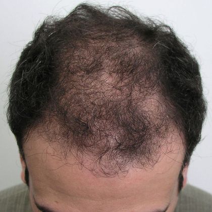 Male Before And After Hair Transplant Photos: Front & Top FUT - Before FUT hair transplant