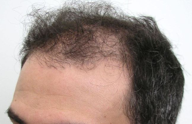 Hair Transplant - Male: Front & Top FUT - Case 46 - Before FUT hair transplant