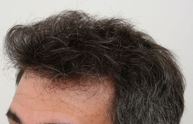 Male Before And After Hair Transplant Photos: Front & Top FUT - After FUT hair transplant