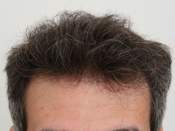 Male Before And After Hair Transplant Photos: Front & Top FUT - After FUT hair transplant