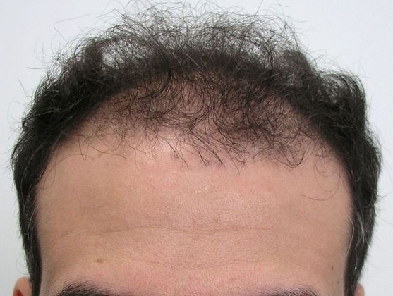 Male Before And After Hair Transplant Photos: Front & Top FUT - Before FUT hair transplant