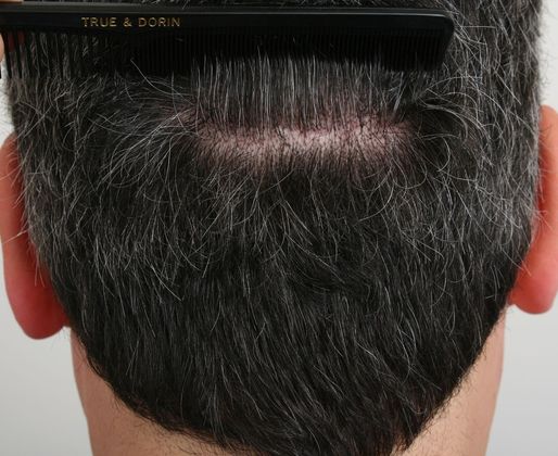 Male Before And After Hair Transplant Photos: Front & Top FUT - Linear scar after FUT hair transplant