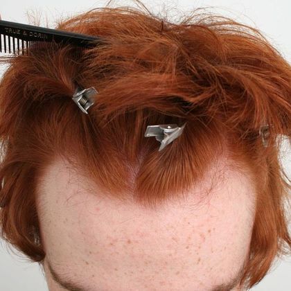 Hair Transplant - Male: Hairline FUE - Case 3 - Before FUE hair transplant