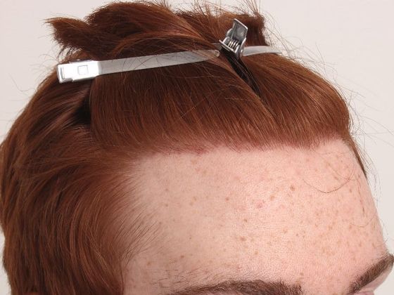 Hair Transplant - Male: Hairline FUE - Case 3 - After FUE hair transplant