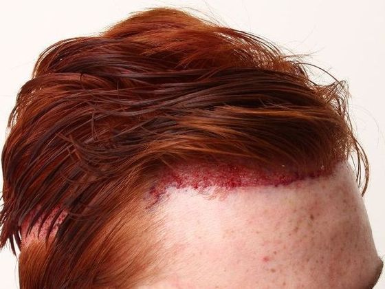 Hair Transplant - Male: Hairline FUE - Case 3 - Post-op FUE hair transplant