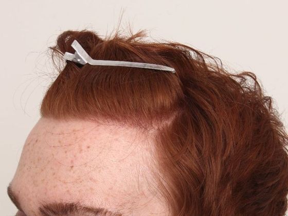 Hair Transplant - Male: Hairline FUE - Case 3 - After FUE hair transplant