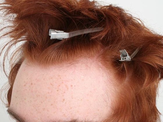 Hair Transplant - Male: Hairline FUE - Case 3 - Before FUE hair transplant