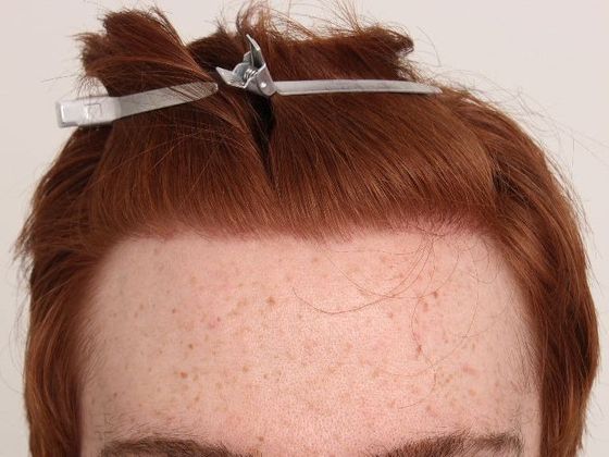 Male Before And After Hair Transplant Photos Hairline FUE (3) - After