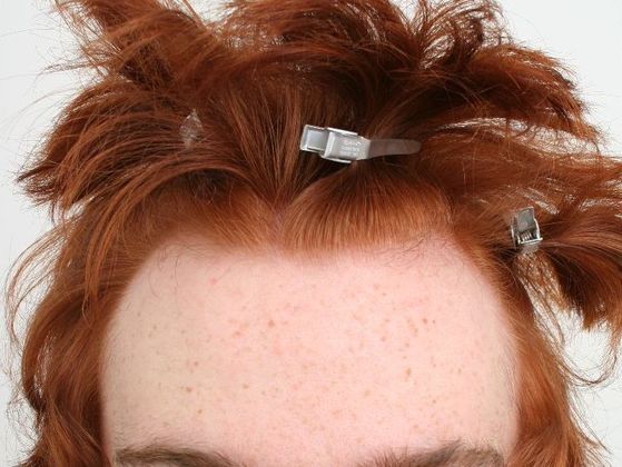 Male Before And After Hair Transplant Photos Hairline FUE (3) - Before