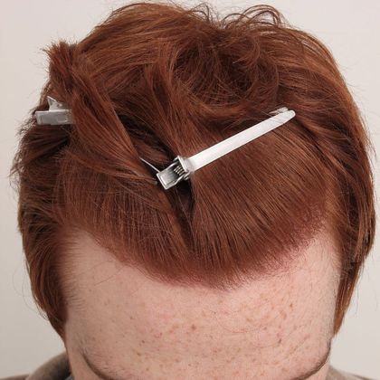 Hair Transplant - Male: Hairline FUE - Case 3 - After FUE hair transplant