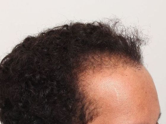 Male Before And After Hair Transplant Photos Frontal FUT (4) - Before