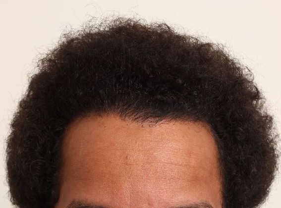 Hair Transplant - Male: Frontal FUT - Case 43 - After FUT hair transplant