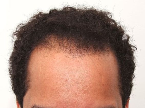 Hair Transplant - Male: Frontal FUT - Case 43 - Before FUT hair transplant