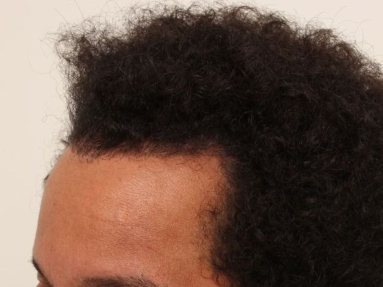 Hair Transplant - Male: Frontal FUT - Case 43 - After FUT hair transplant
