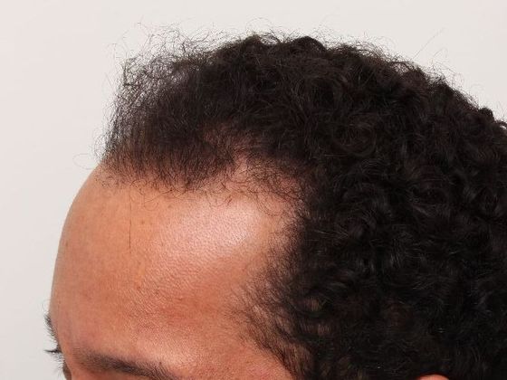Hair Transplant - Male: Frontal FUT - Case 43 - Before FUT hair transplant