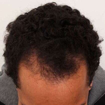 Hair Transplant - Male: Frontal FUT - Case 43 - Before FUT hair transplant